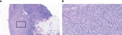 Case report: Kikuchi-Fujimoto disease: unveiling a case of recurrent fever and enlarged cervical lymph nodes in a young female patient with a literature review of the immune mechanism